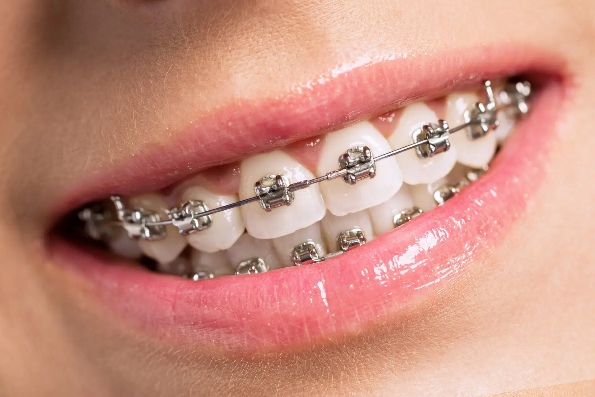 Braces Treatment